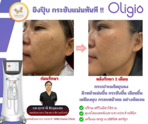 รีวิวยกกระชับ ปรับรูปหน้า 01