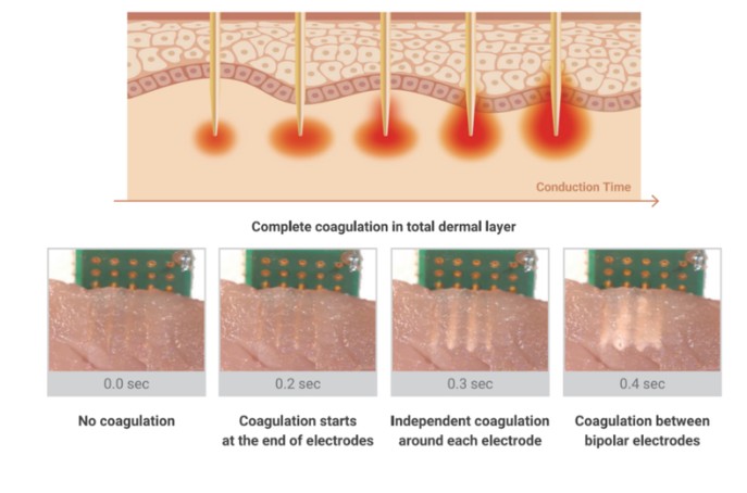 การจัดการรูขุมขน